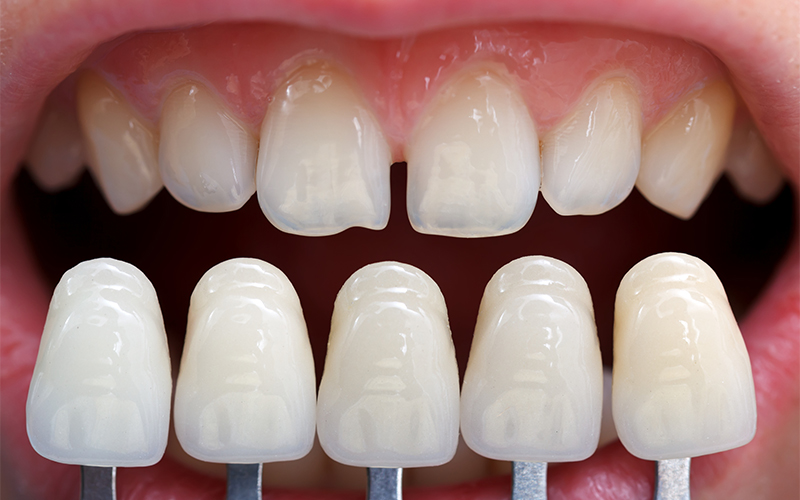 dental veneers
