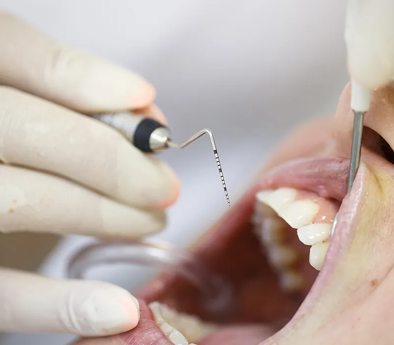 receding gums