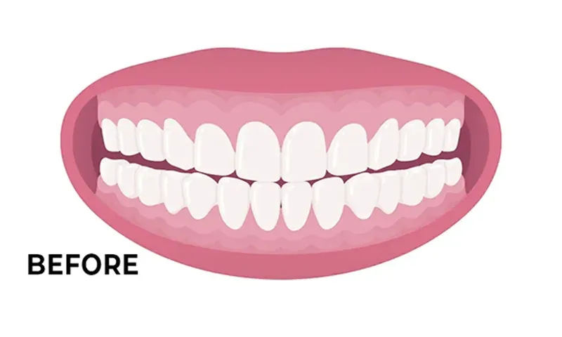 Gummy smile before and after