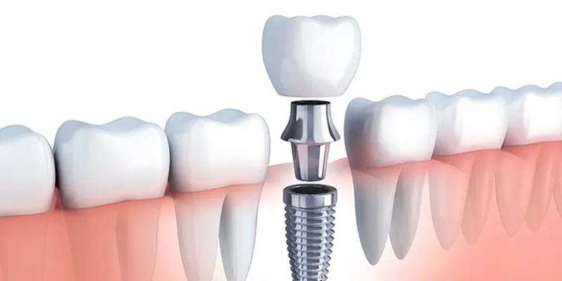 dental implants