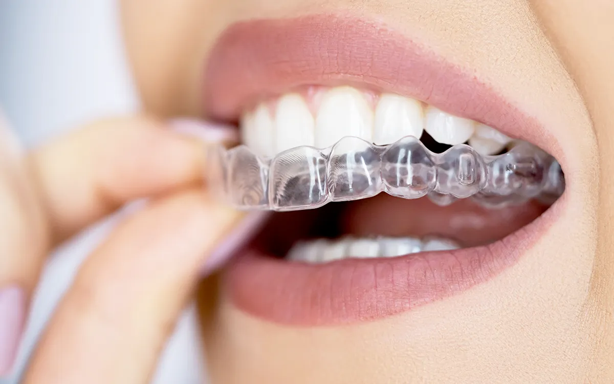 Clear aligner