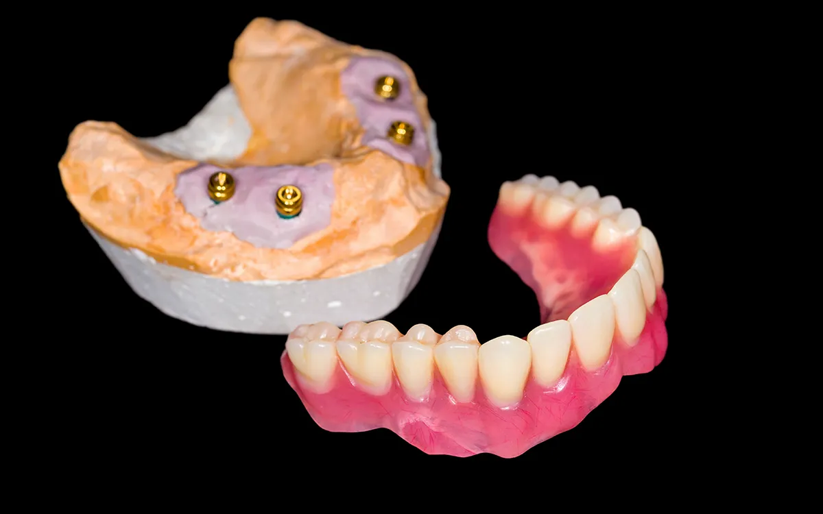 Implant-supported dentures